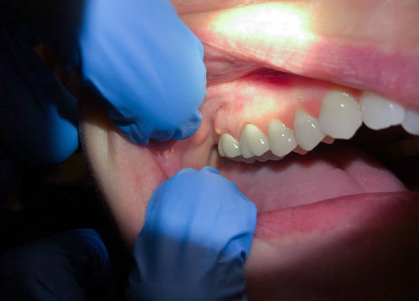Best Emergency Broken Tooth Repair in Smith Mills, MA