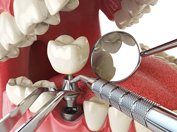 Best Emergency Wisdom Teeth Removal in Smith Mills, MA